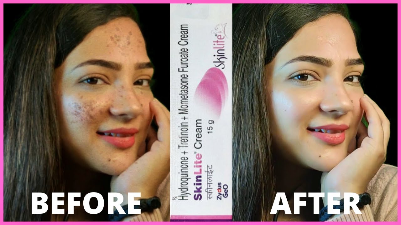 Skinlite Cream Review in Hindi | skin lite cream ko kaise use kre | Uses,Side Effects and Results