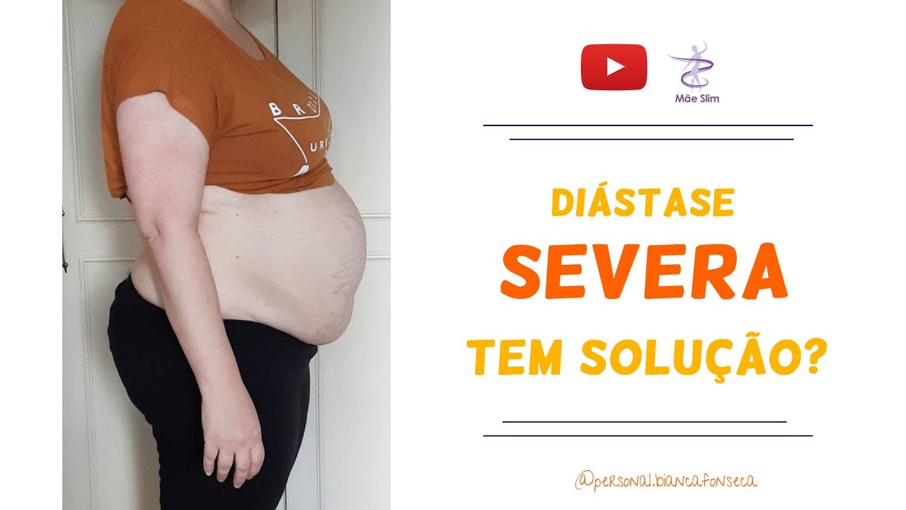 QUANDO UMA DIÁSTASE É SEVERA?