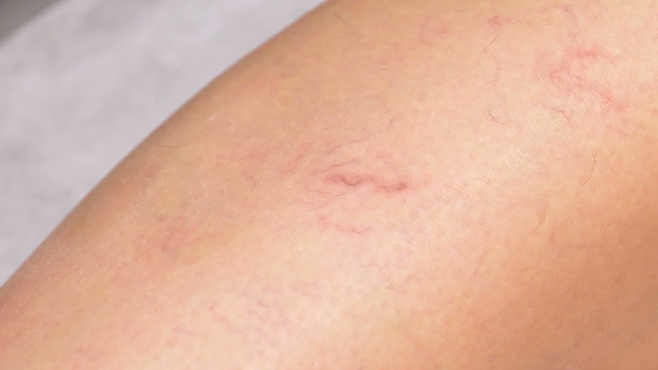 El Dr. Pedro Santos explica cómo realiza un tratamiento vascular con láser Nd:YAG 1064
