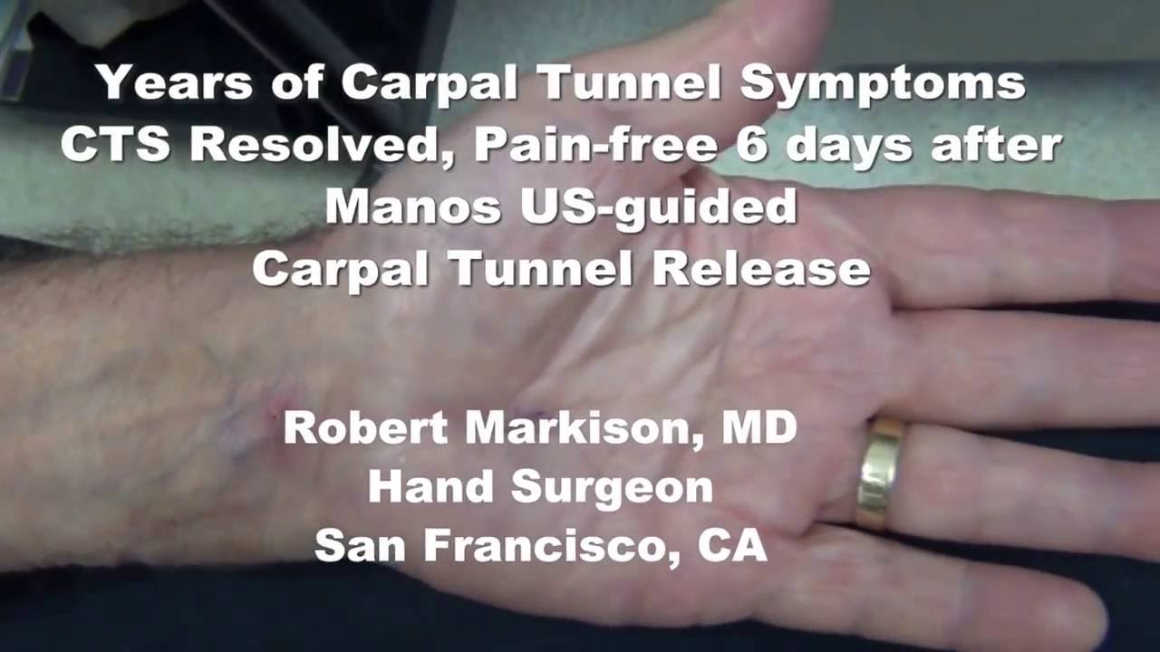 Numbness Gone 6 Days After Manos US-guided Carpal Tunnel Release