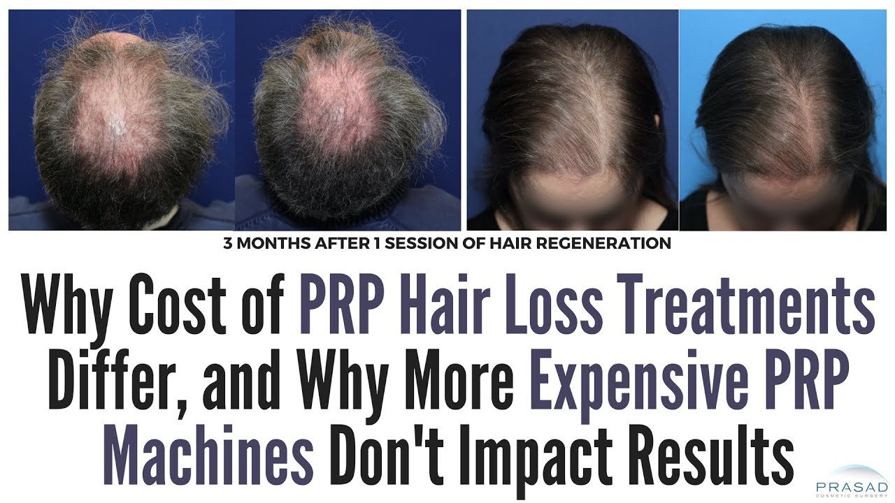 Factors of Differing Costs of PRP Hair Loss Treatments, and Why Expensive PRP Machines are Unproven