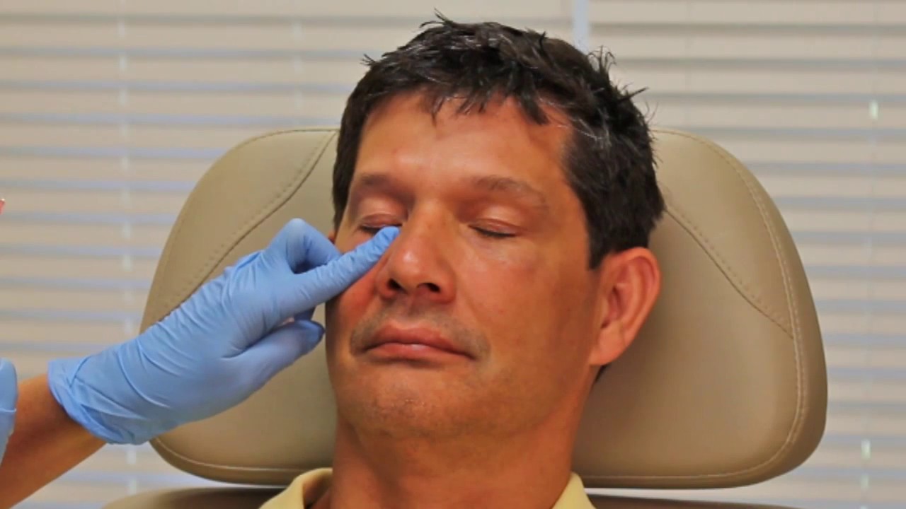 Under The Eye Restylane