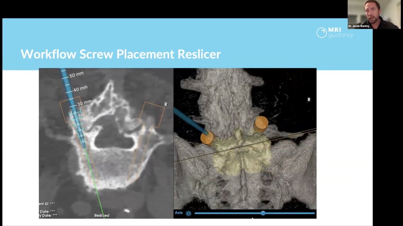 Webinar: Surgical Precision with Zero Radiation & Efficient Workflow
