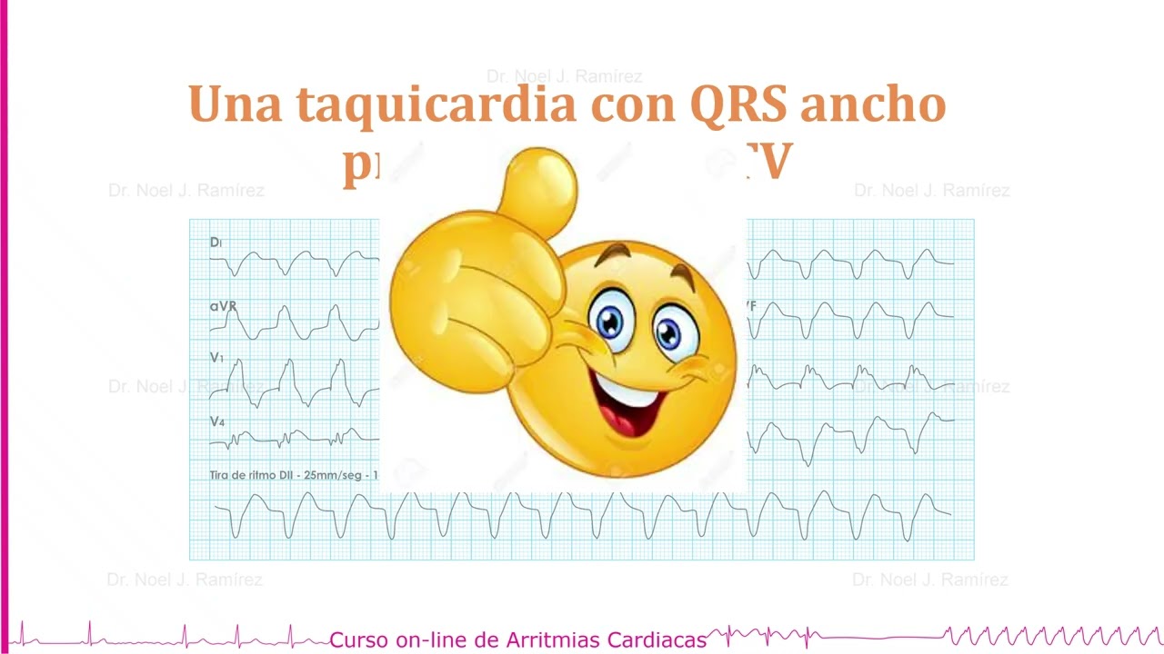 Curso de Arritmias Cardiacas en Marzo 2026