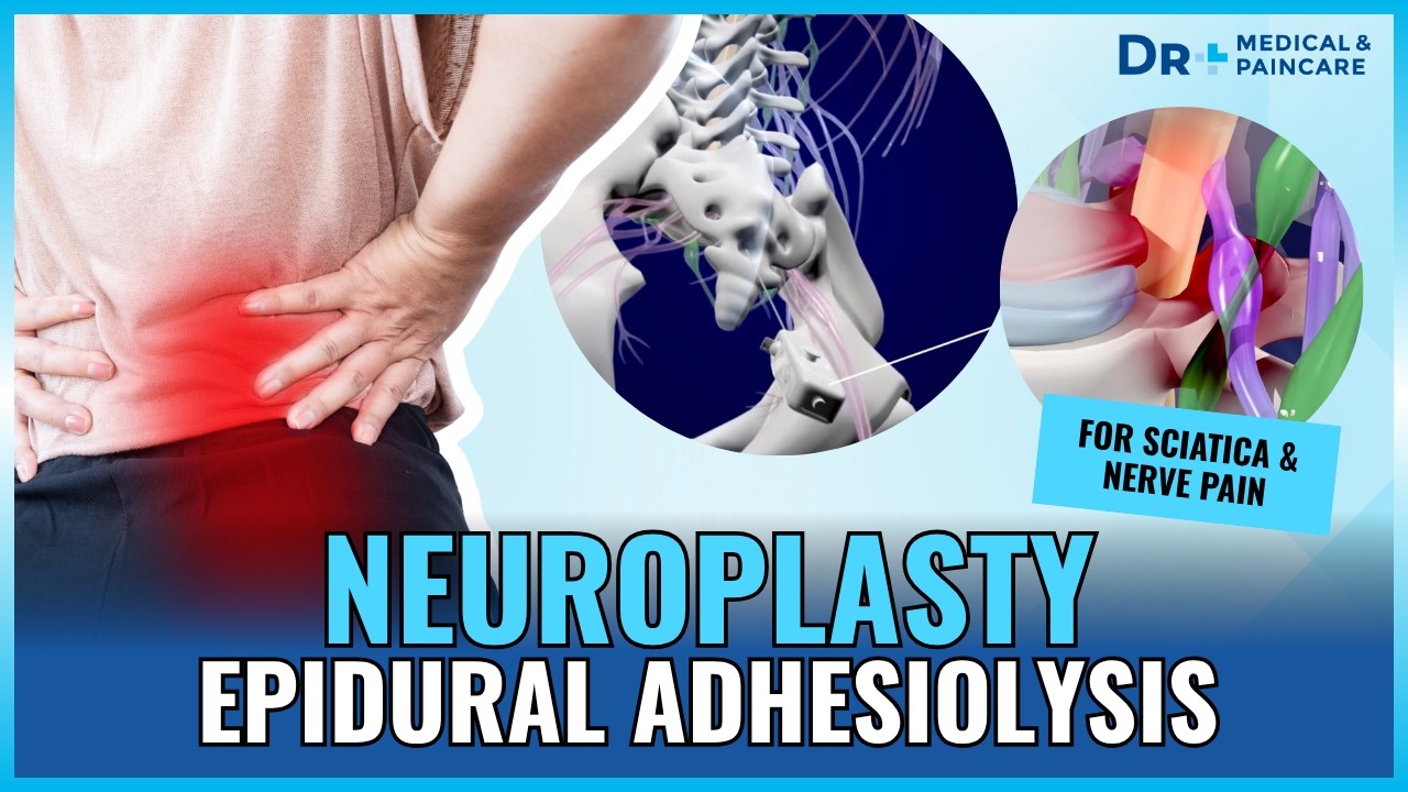 Neuroplasty (or Epidural Adhesiolysis) - Minimally Invasive Pain Treatment