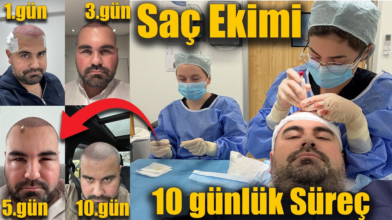4100 ROOTS 9900 HAIR TRANSPLANTATION! 10 Days Complete Process - I Became Japanese | Super Result...