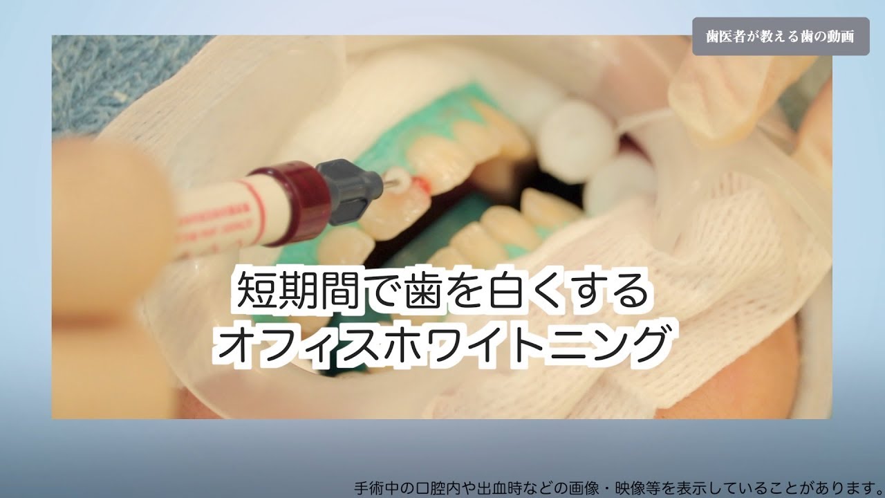 1日で歯を白くするオフィスホワイトニング