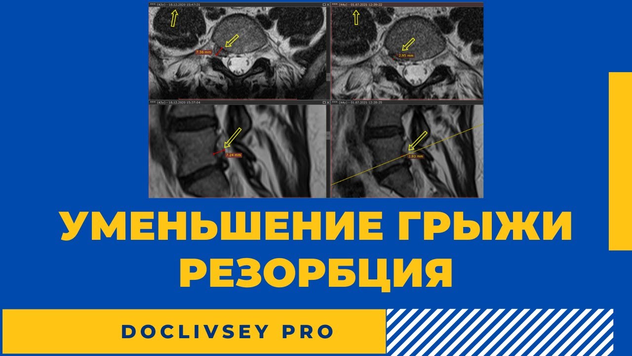 Резорбция грыжи, виды грыж, уменьшение грыжи