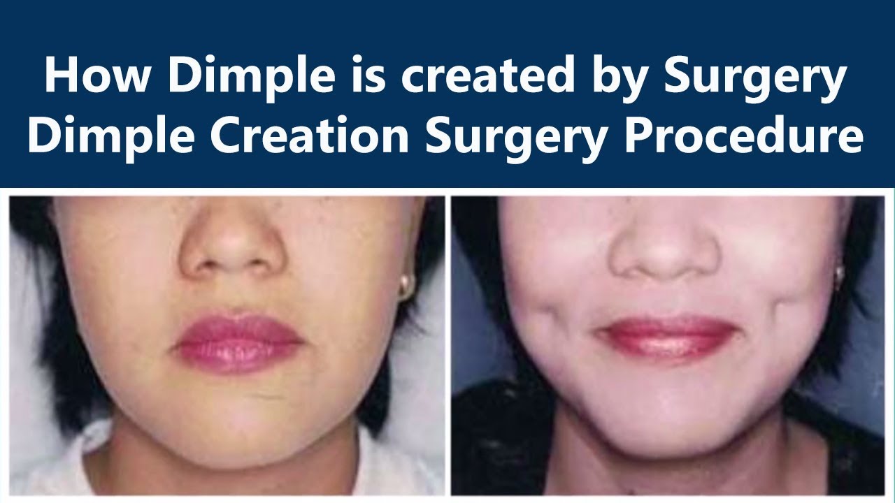 See How Dimple Is Created By Dimple Creation Surgery | The Esthetic Clinics, India