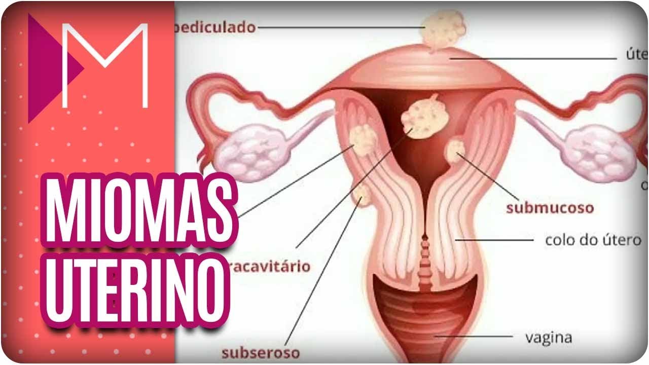 Miomas Uterino - Mulheres (10/04/18)