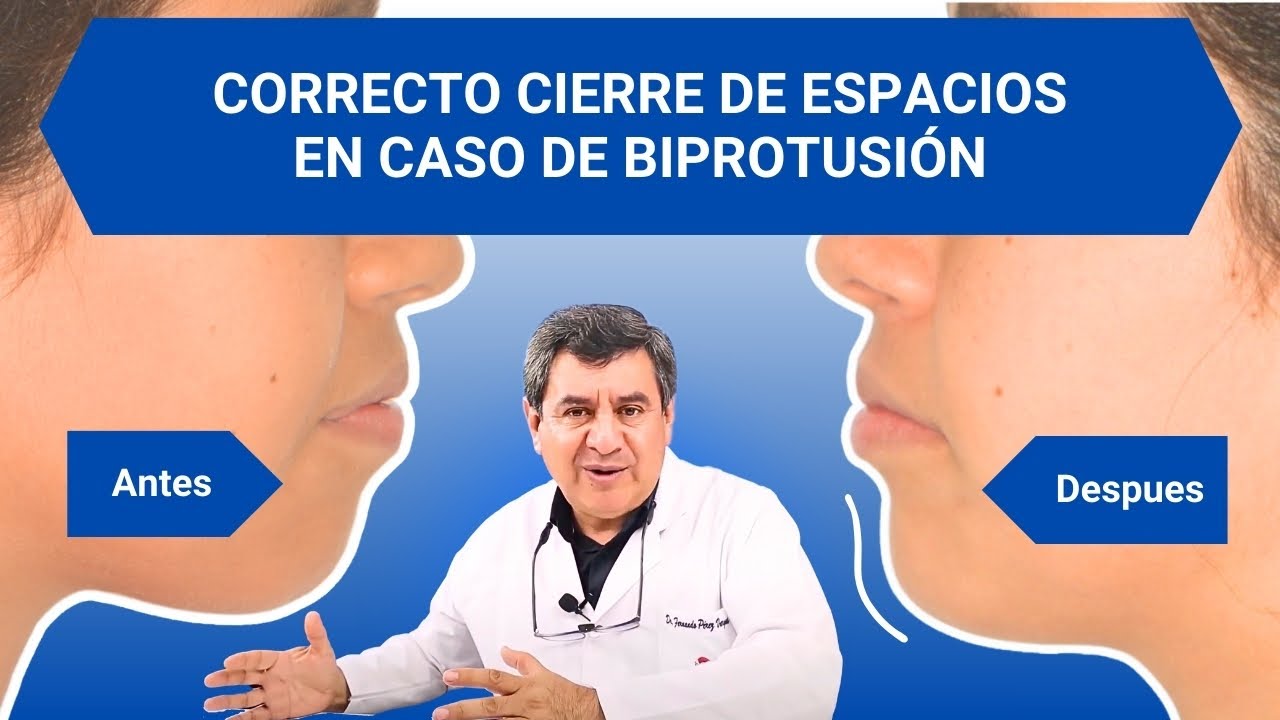 Cuando realizar extracción y cierre de espacios en ortodoncia