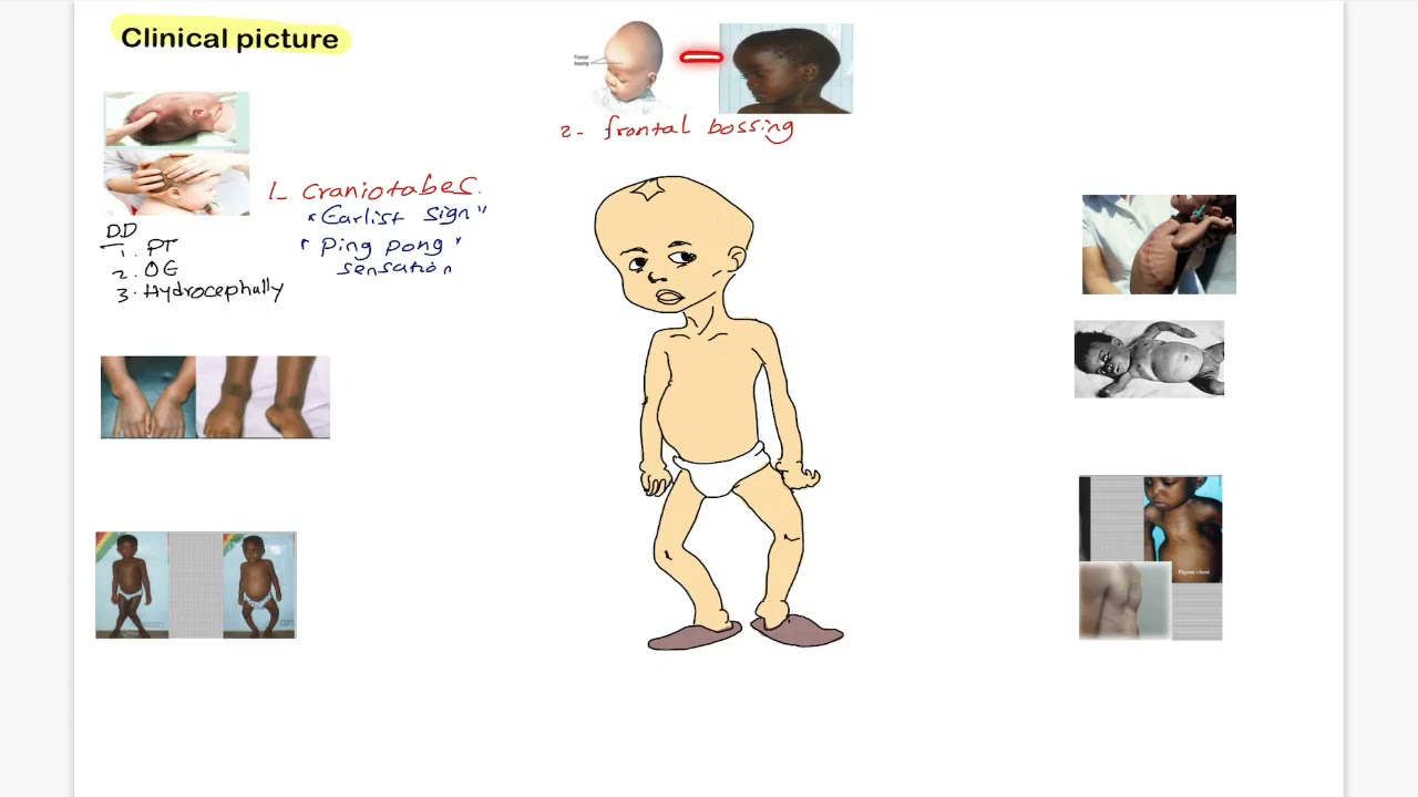 Rickets 2