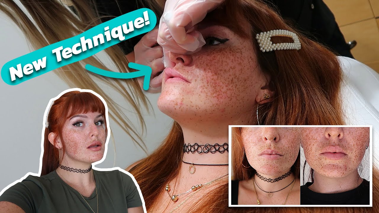 A VERY Detailed Lip Injection Experience | Lip Fillers on SHORT Lips | VERSA Lip Filler
