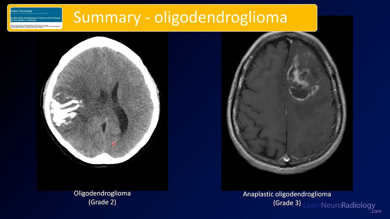 Emergency Imaging of Brain Tumors: Oligodendrogliomas & Others