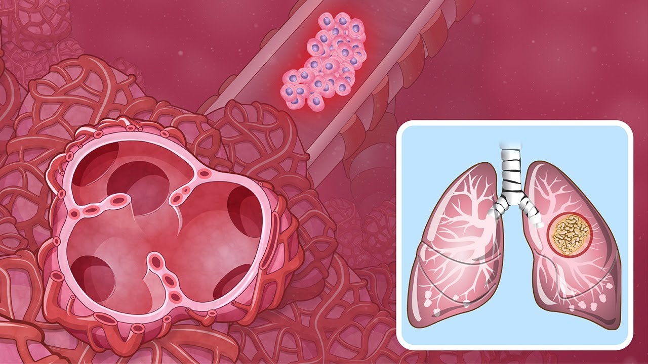 Comprender el cáncer de pulmón de células no pequeñas