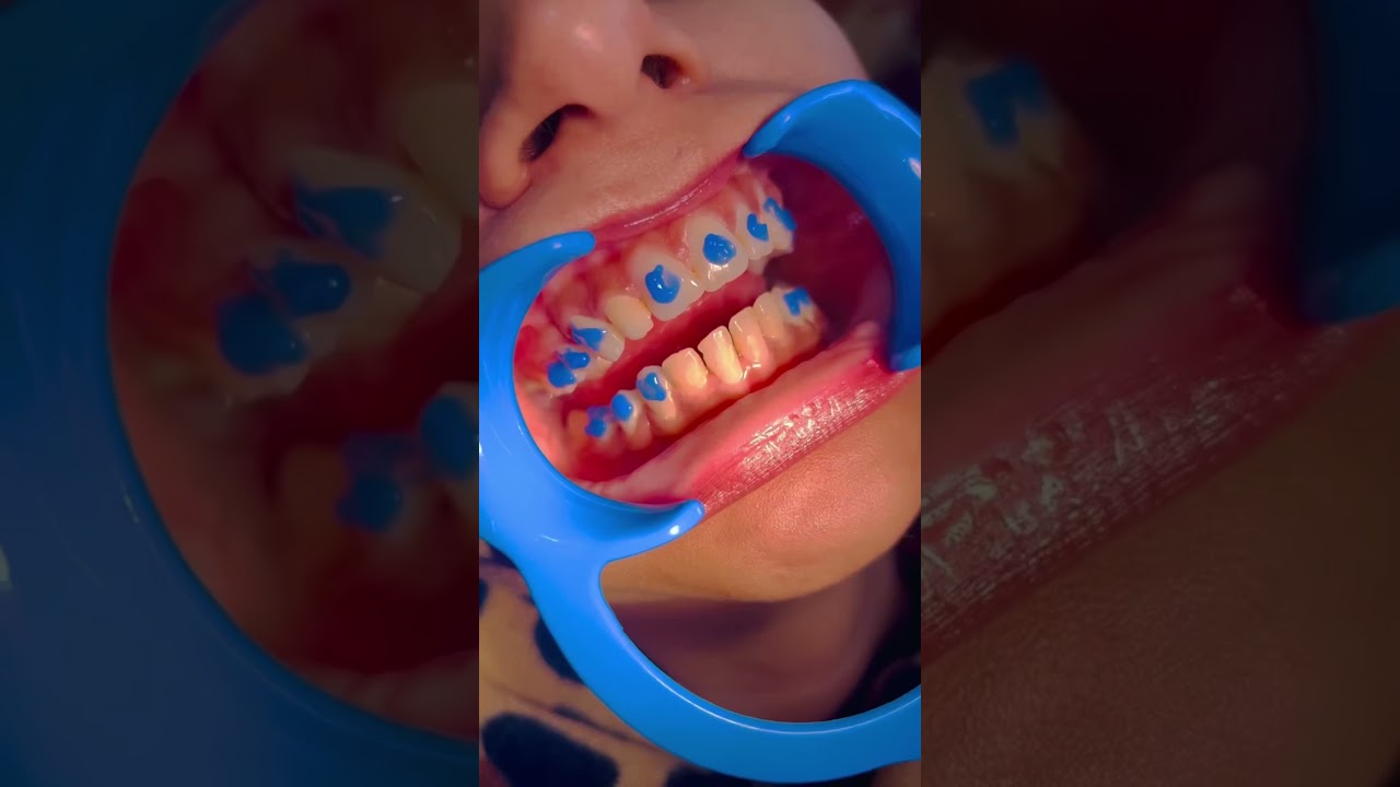 Delivery Of Dental Aligners | Aligners Treatment | Toothsi Aligners 