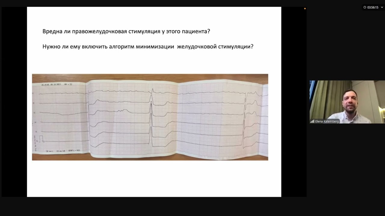 Когда СРТД может подождать или не потребоваться. Стимуляция левой ножки пучка Гиса