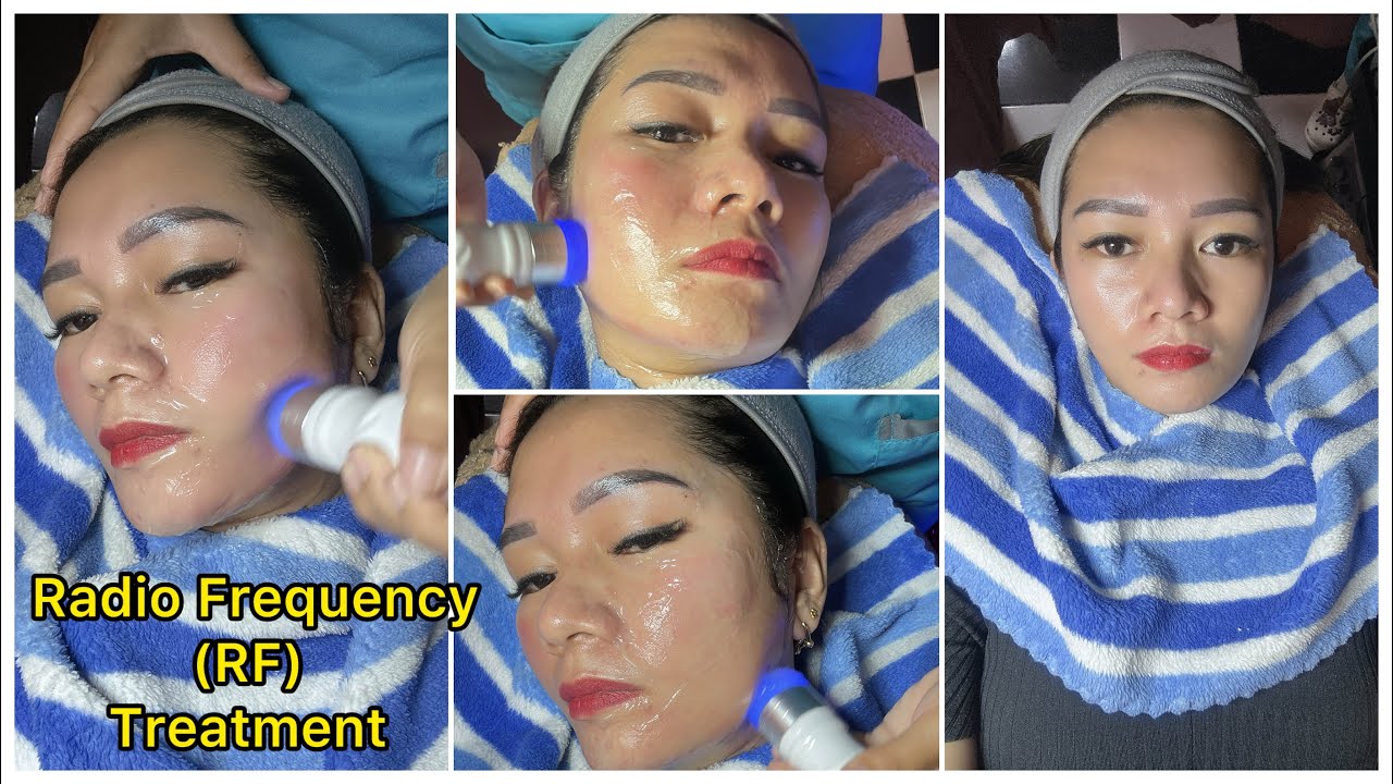 Radio Frequency (RF) Treatment  