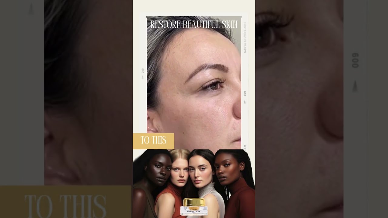 ABERA MELASMA CREAM: Fast Solution for Melasma and Dark Spot 