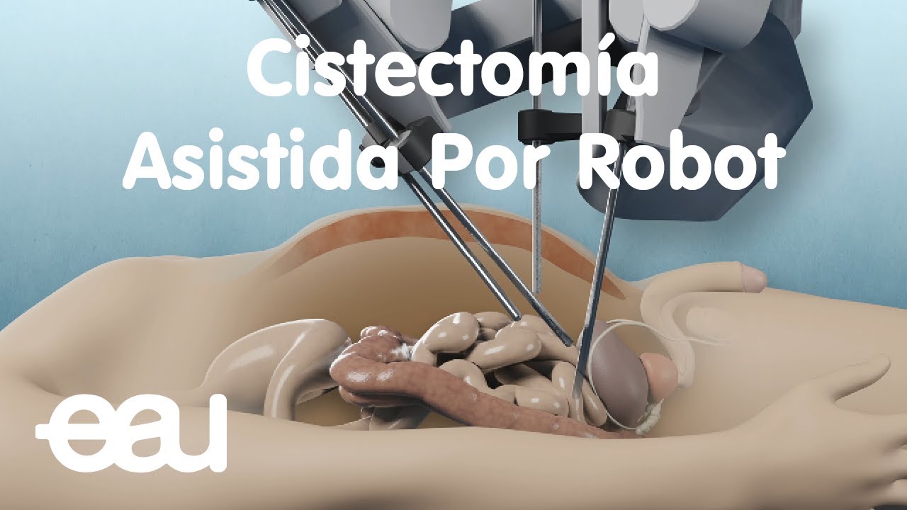 Cistectomía Asistida Por Robot