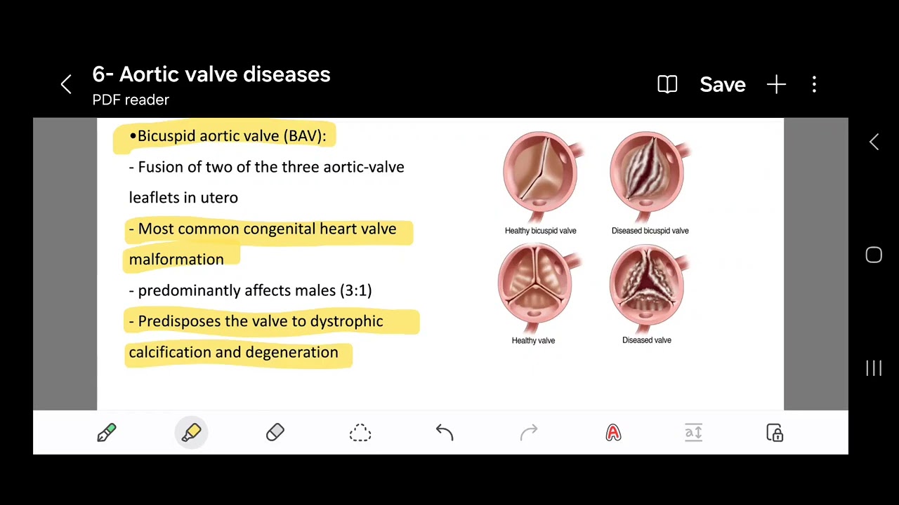Aortic Valve Diseases (Part 1)  