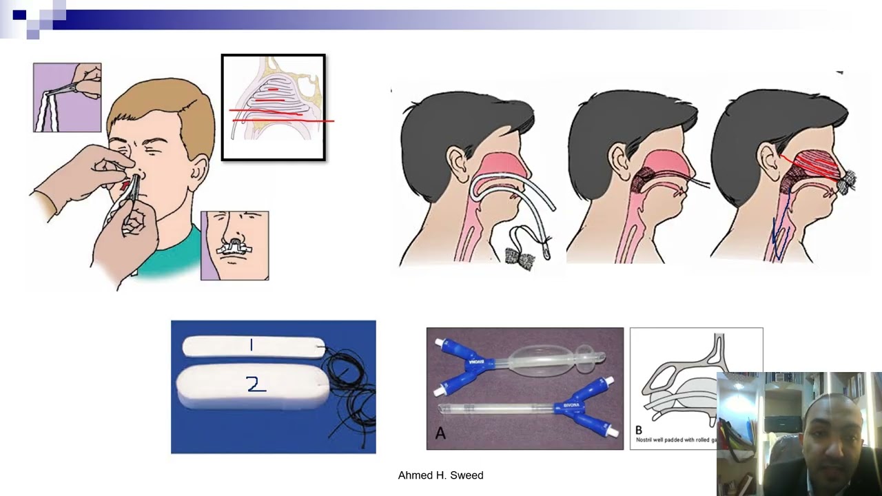 2- nose emergency - dr. ahmed hassan sweed