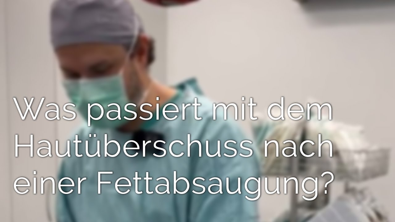 Was passiert mit dem Hautüberschuss nach meiner #Fettabsaugung? #LipoTV