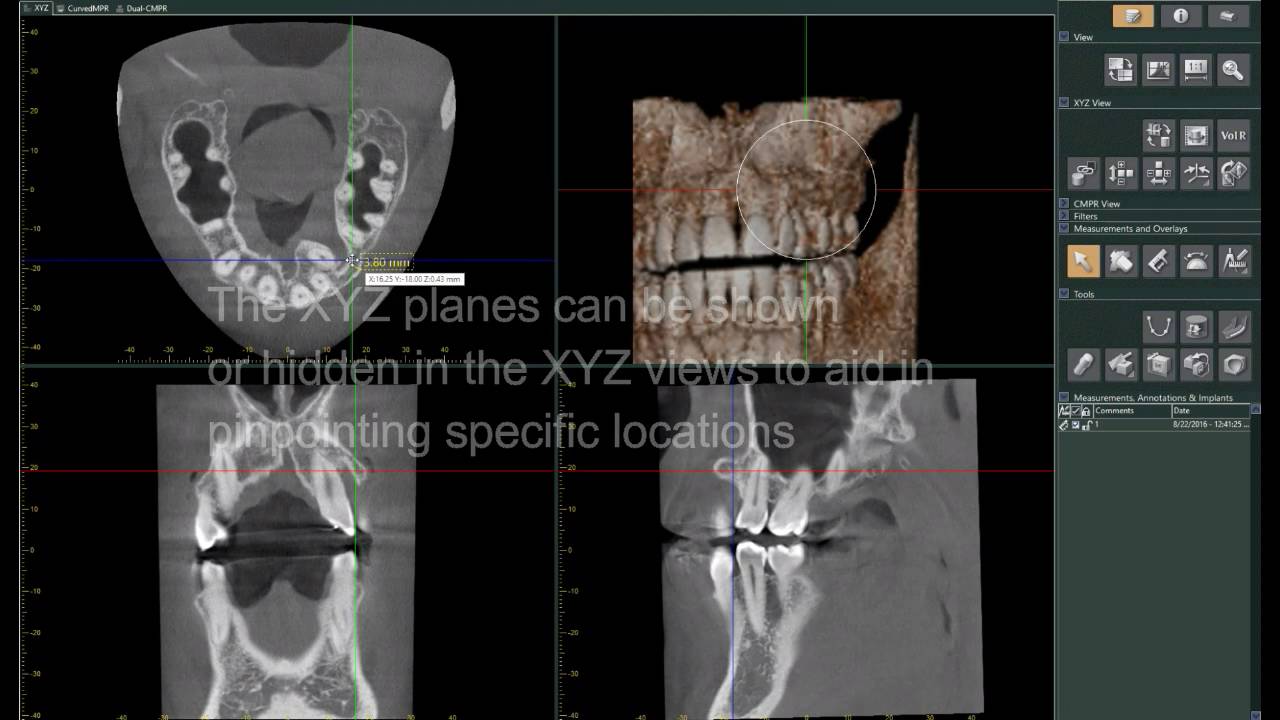Dental TI Presents iDixel and the Morita R100 Navigating a 8x10 FOV