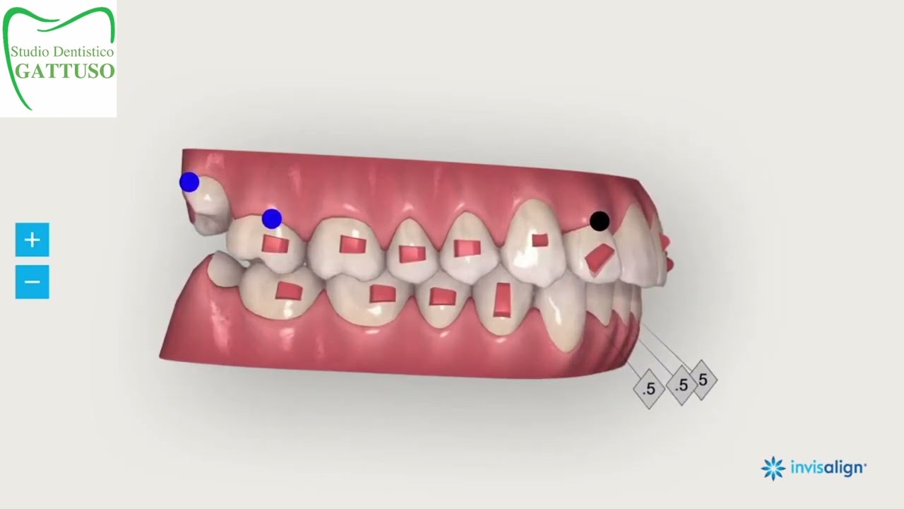 Allineatori invisibili simulazione 3D del risultato finale