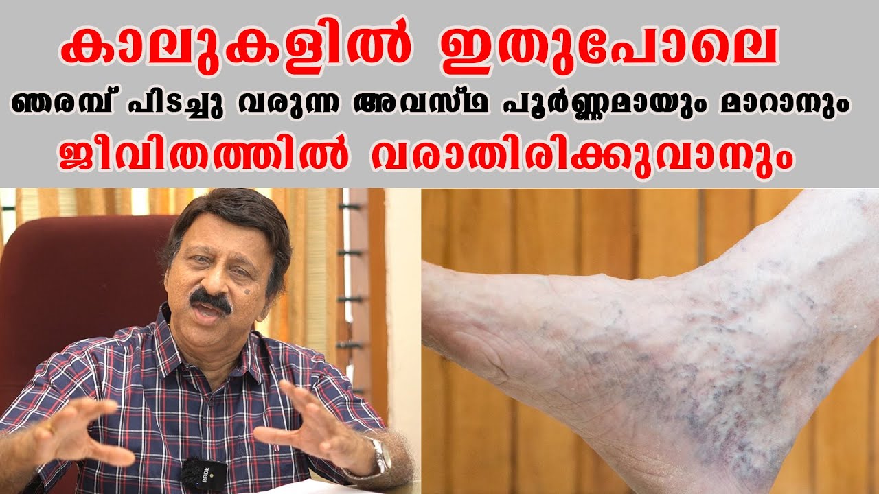 കാലുകളിൽ ഇതുപോലെ ഞരമ്പ് പിടച്ചു കറുത്ത് വരുന്ന അവസ്ഥ പൂർണ്ണമായും മാറാൻ /Dr Gopinatha Pili
