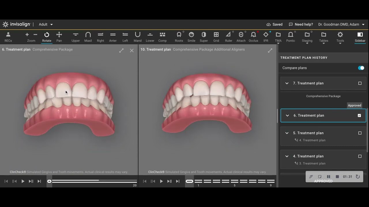 A Functional Benefit to a Moderate Orthodontic Invisalign Correction