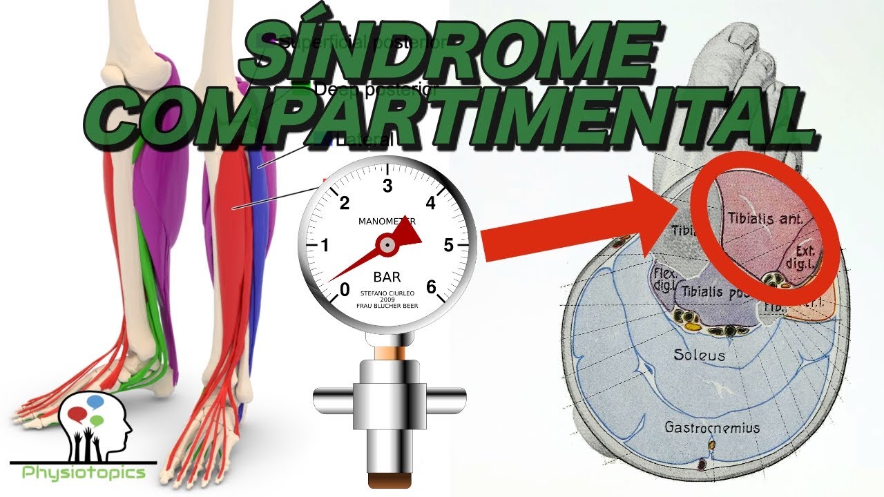 S&iacute;ndrome Compartimental Agudo