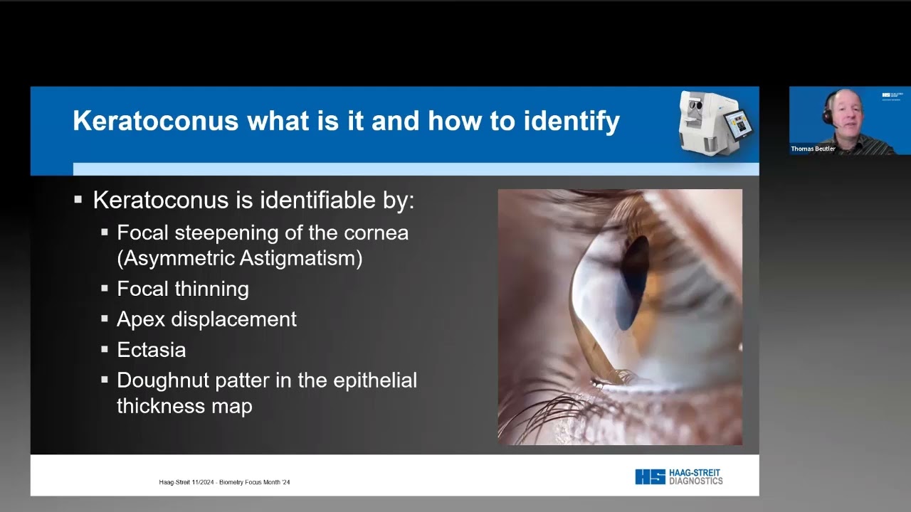 Eyestar: Topography & corneal ectasia display – Thomas Beutler