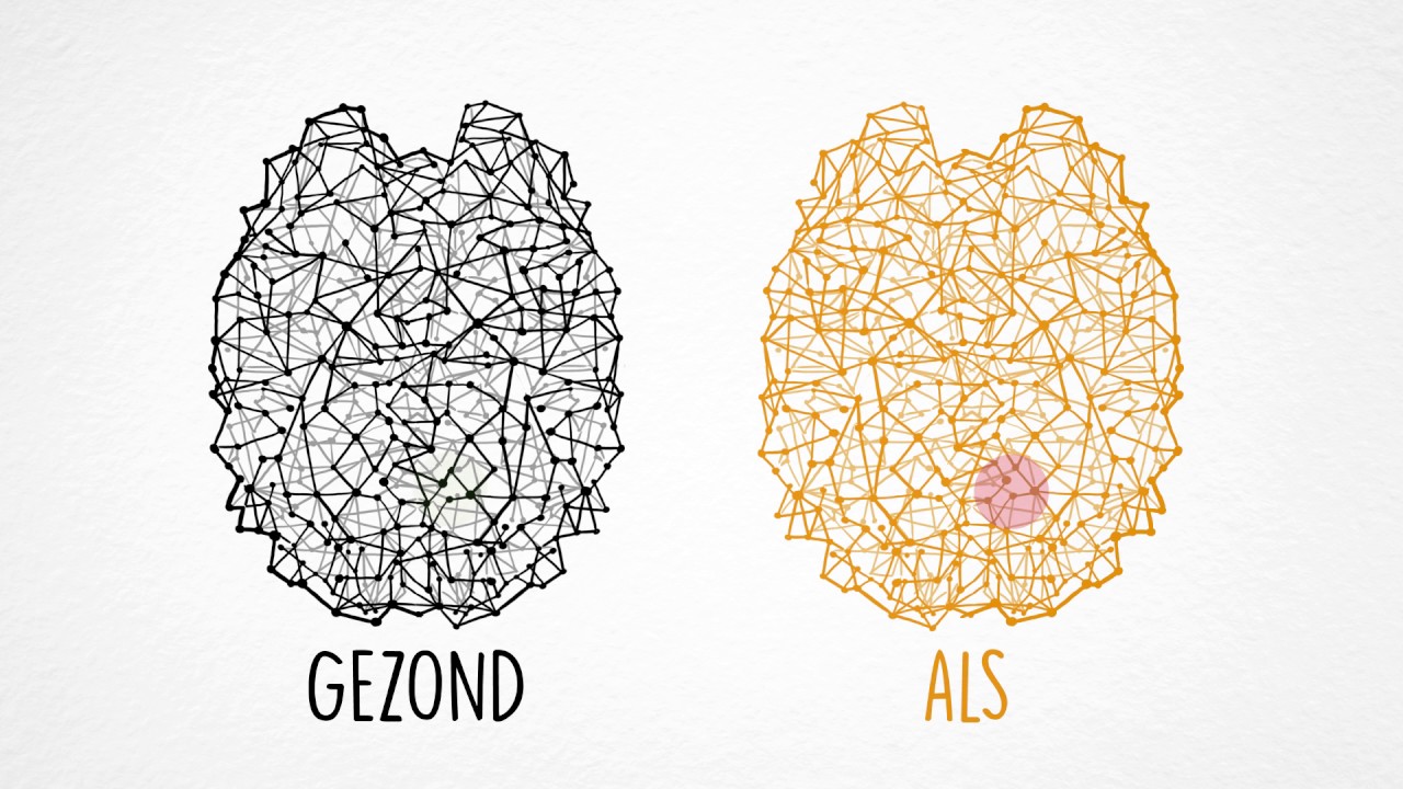 ALS Onderzoek - MRI-scans
