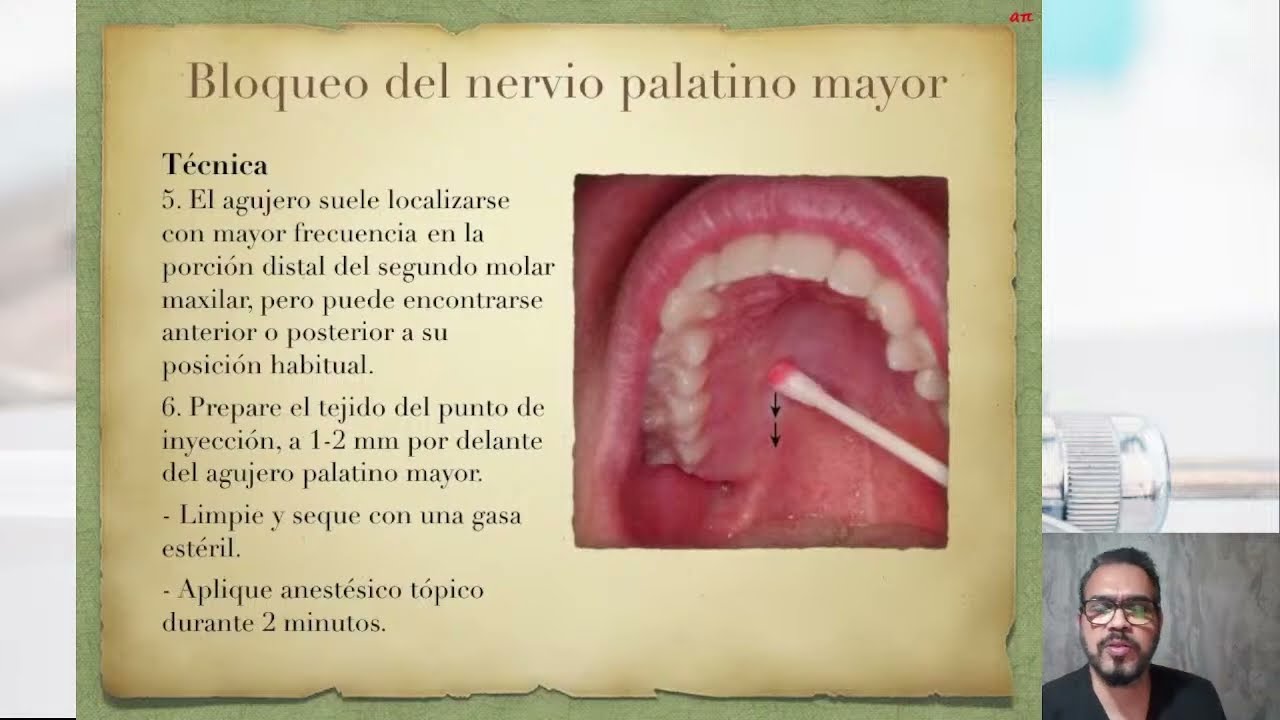 Técnica de Anestesia para el Nervio Palatino Mayor (Posterior)
