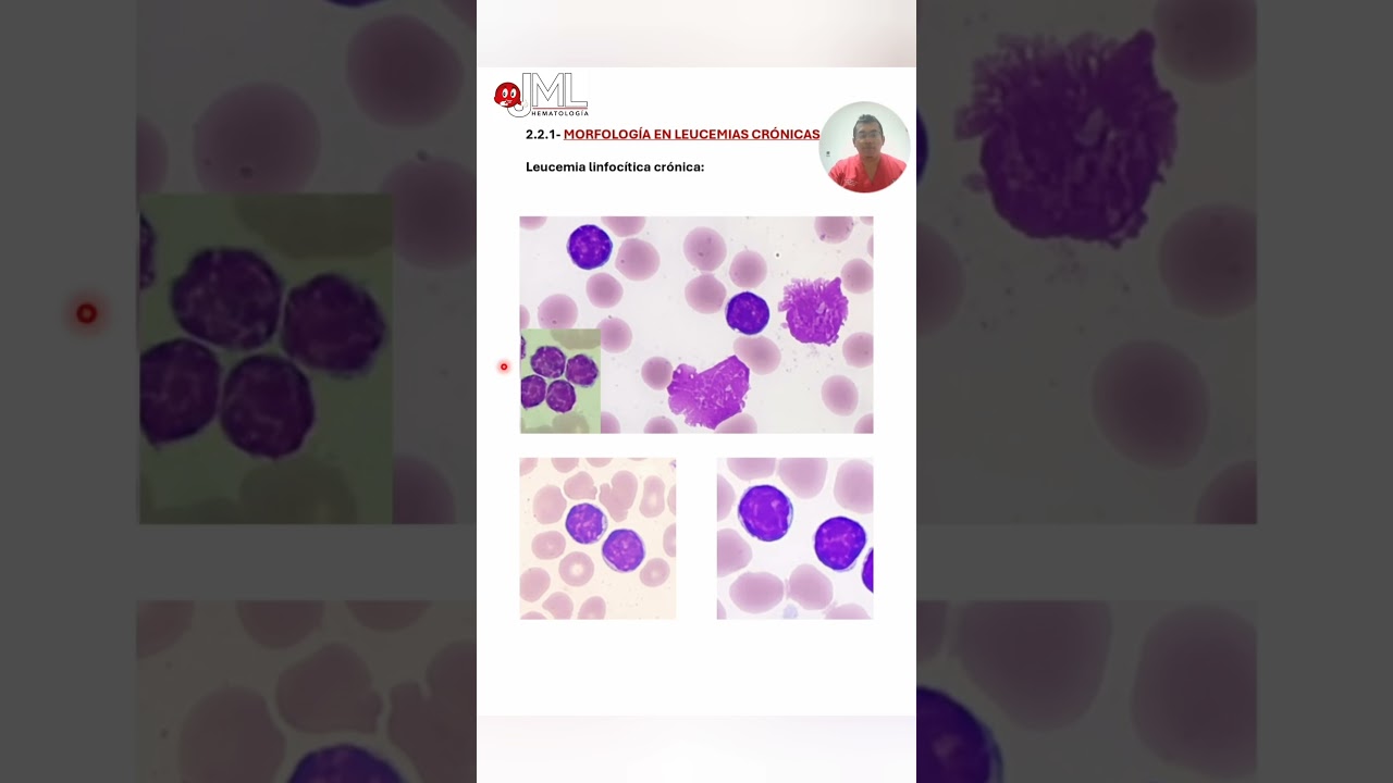 MORPHOLOGY: Chronic lymphocytic leukemia and Gumprecht shadows.