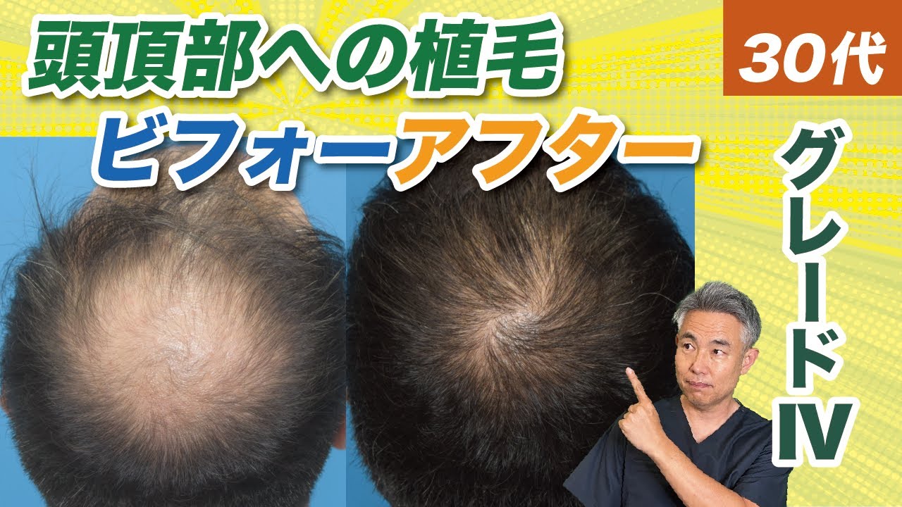 【症例紹介】30代グレードⅣ 頭頂部植毛10ヶ月後のリアル