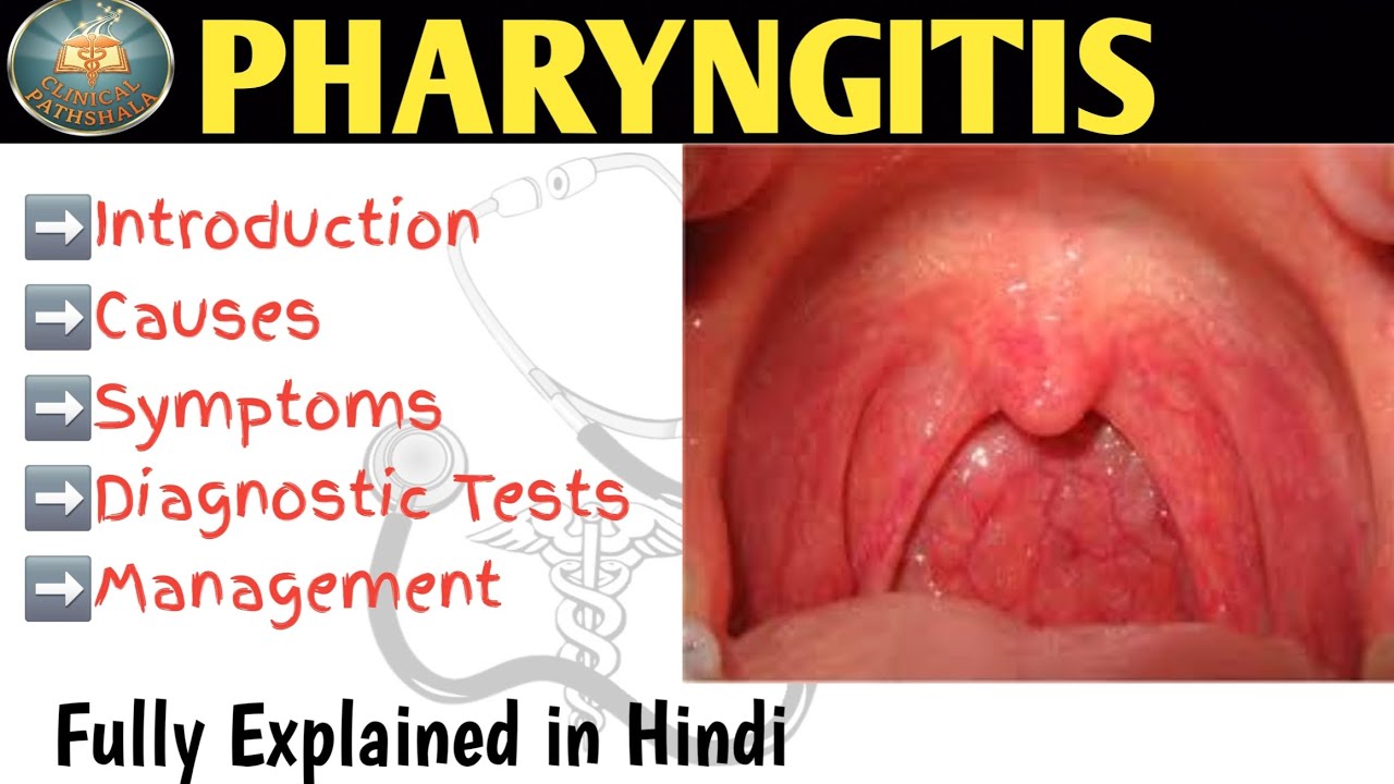 Pharyngitis | Causes, Symptoms, Diagnosis, and Management Explained in Hindi 