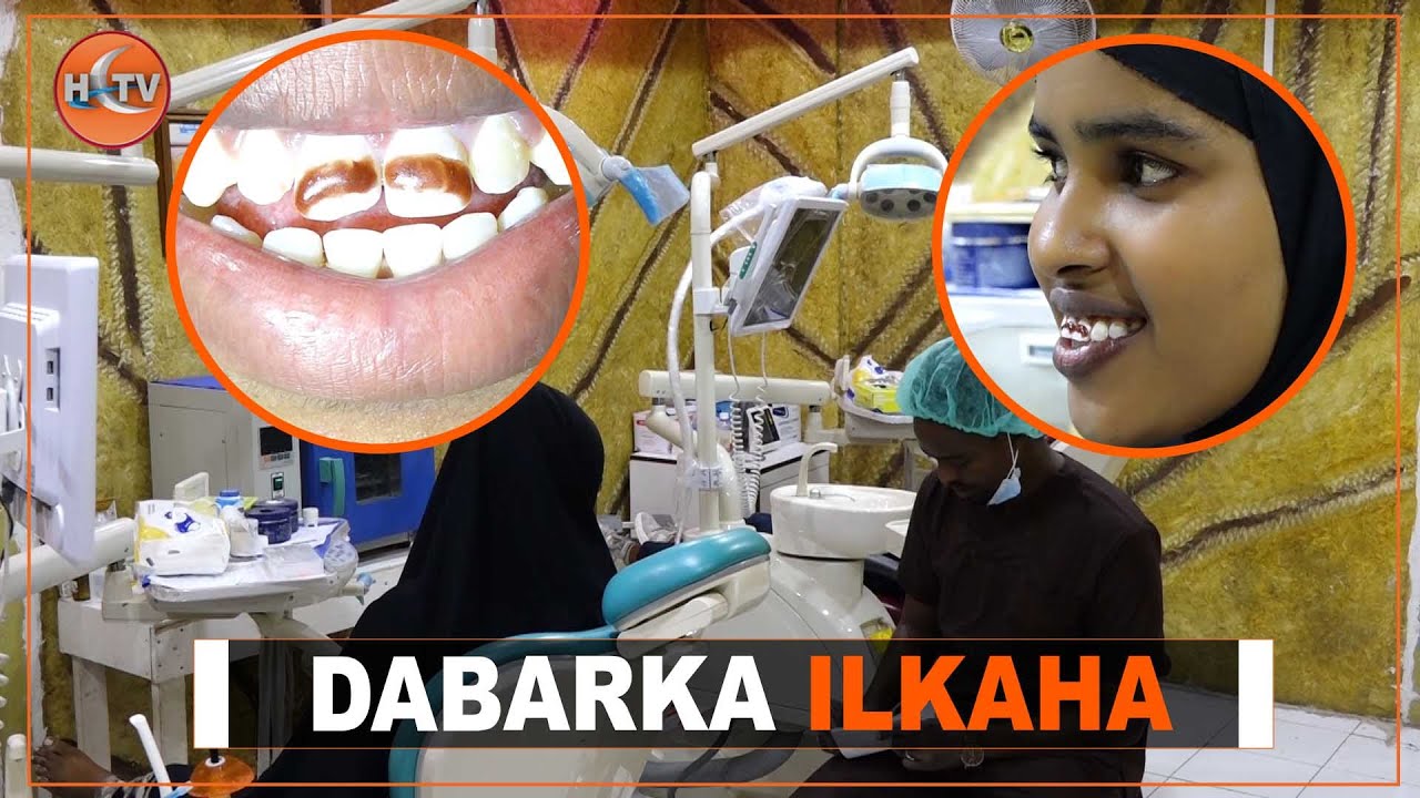 Warbixin: Dabarka Ilkaha La Sameysto Oo Magaalada Muqdisho Ku Soo Badanaya Mudooyinkii Danbe.