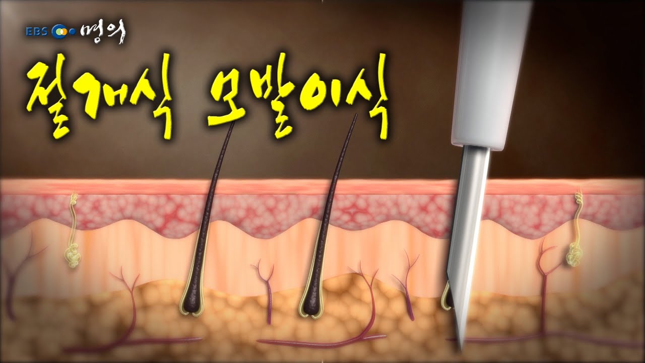 [명의 의학백과📖] 절개식 모발이식