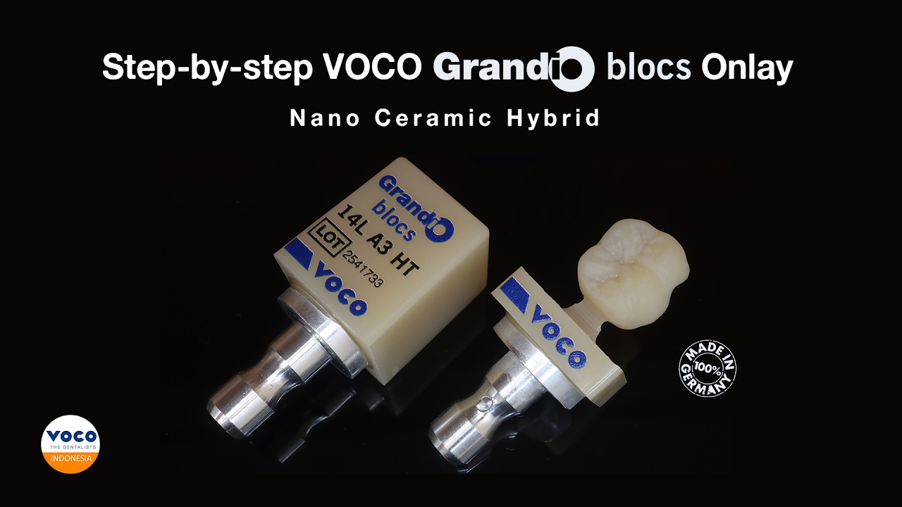 Step-by-step Milling VOCO Grandio Blocs Onlay Single-tooth Restorations Nano Ceramic Hybrid CAD/CAM