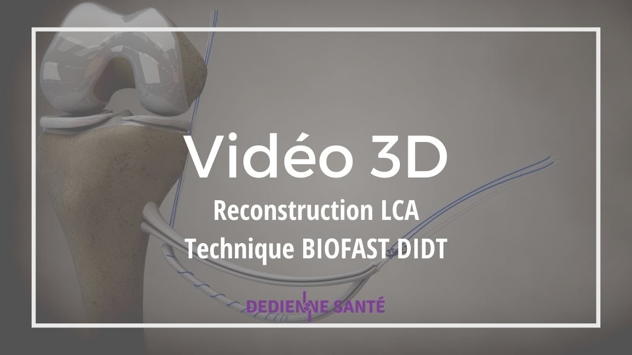 Reconstruction du LCA 3D - Technique BIOFAST DIDT du Dr MEYER