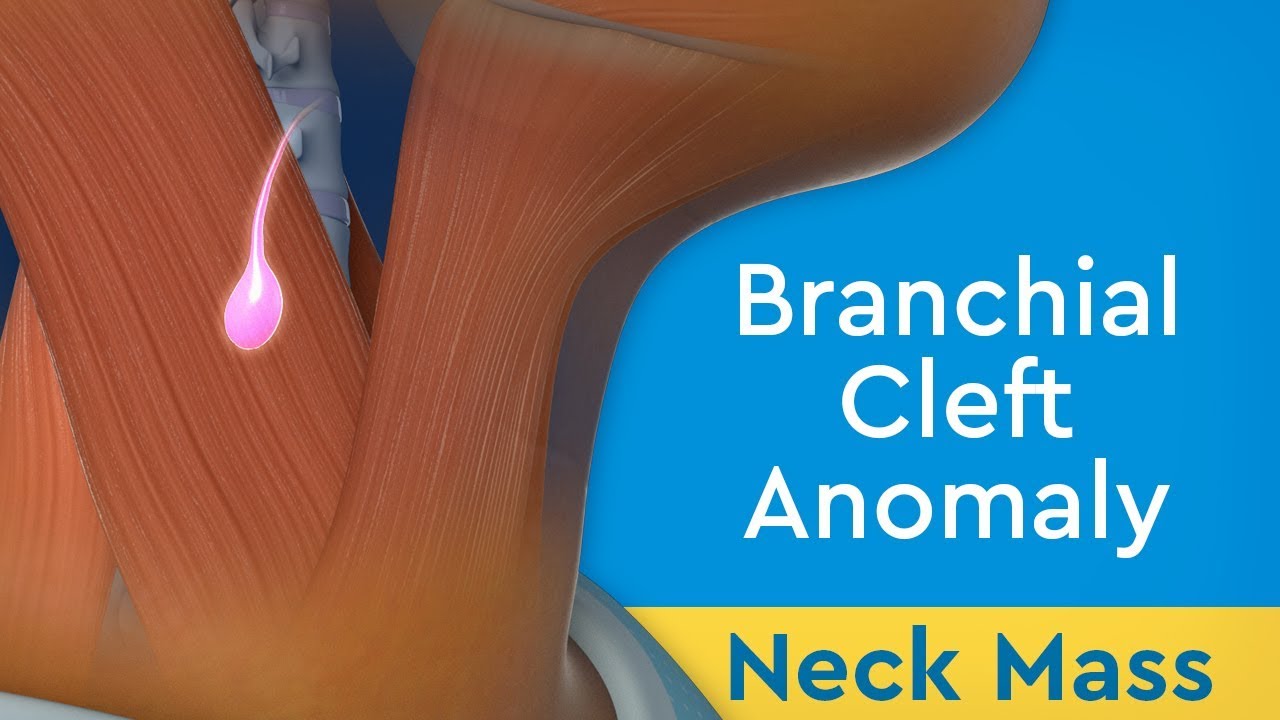Neck Mass: Branchial Cleft Anomaly