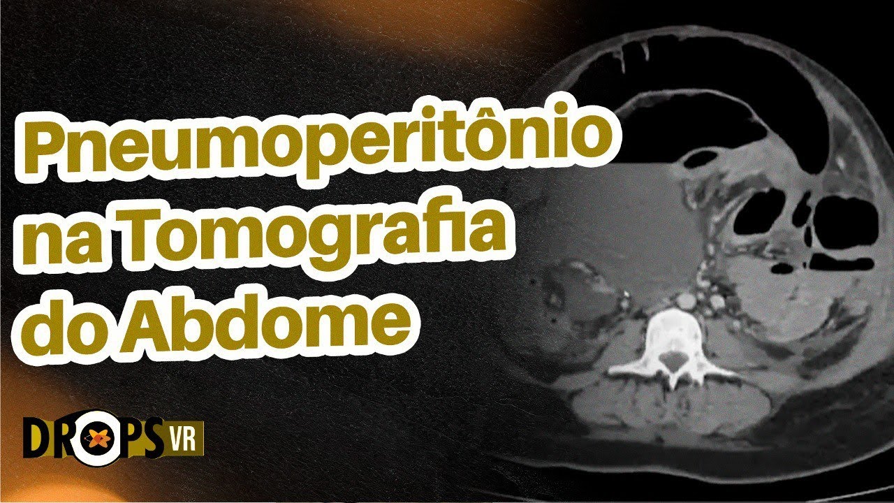 RECONHECENDO O PNEUMOPERIT&Ocirc;NIO NA TOMOGRAFIA DO ABDOME I VOC&Ecirc; RADIOLOGISTA