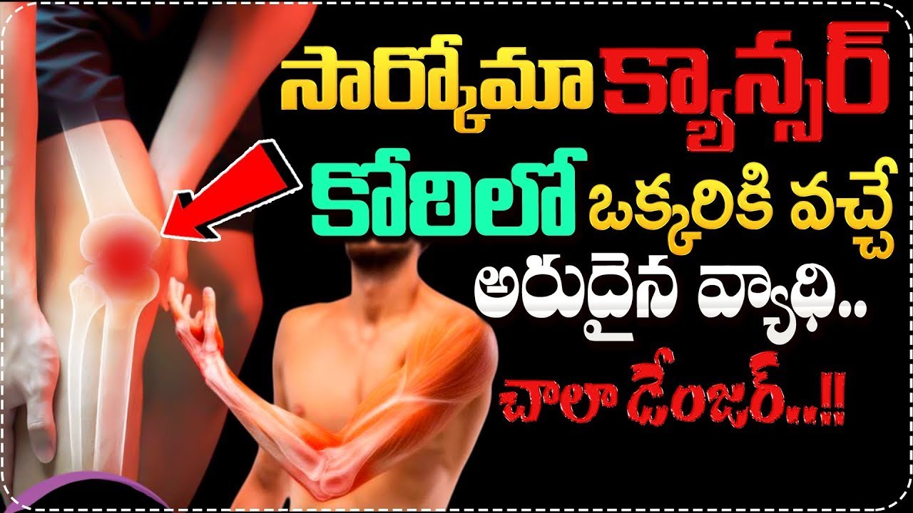 సార్కోమా క్యాన్సర్ లక్షణాలు ఇవే..| Cancer that affects only one in a million people | Sarcoma Cancer