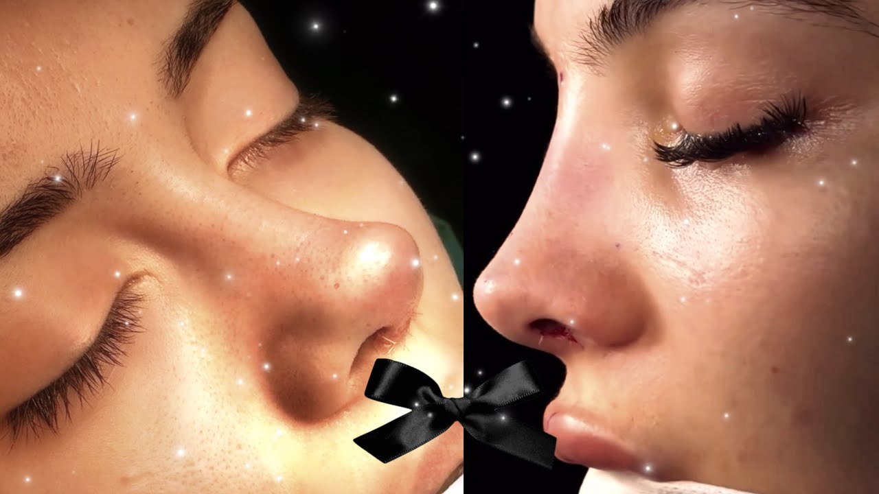 💉Series:2 ｡* Scientifically perfect dolly nose surg 🎀☆ [50 Trillion affs]