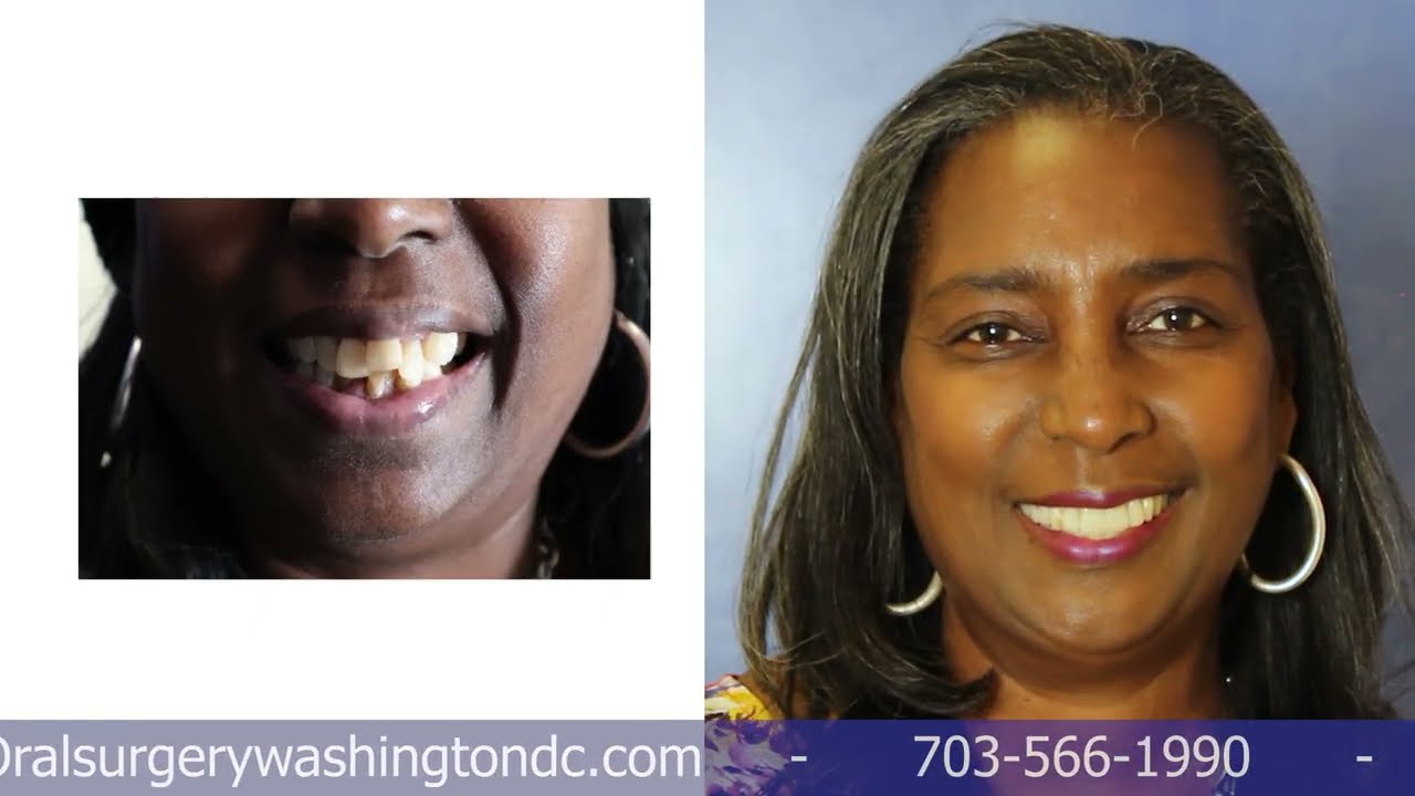 Full Mouth Dental Implants: A New Smile in One Procedure