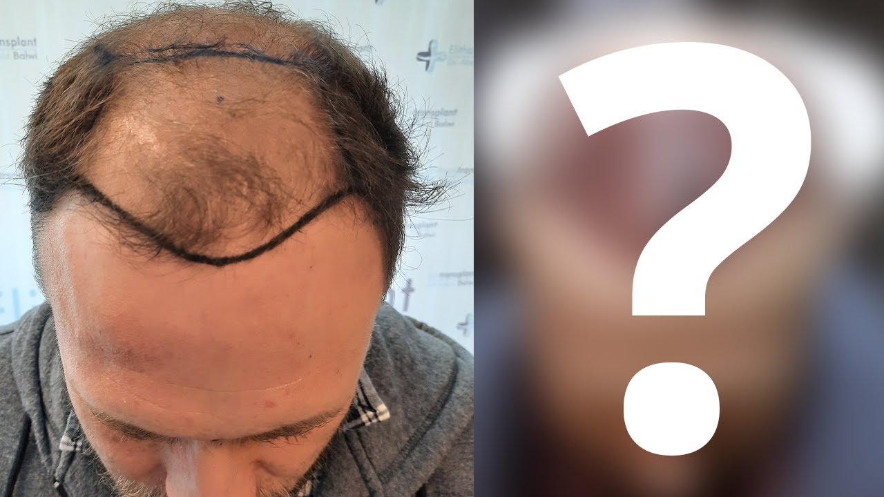 Michael's Hair Transplant Story | Before, During + After His Transplant in Turkey