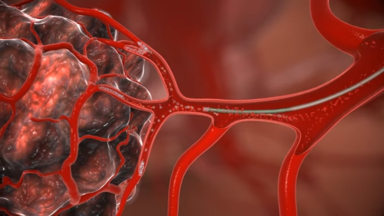 Agile Devices Angler™ steerable catheter - 3d animation