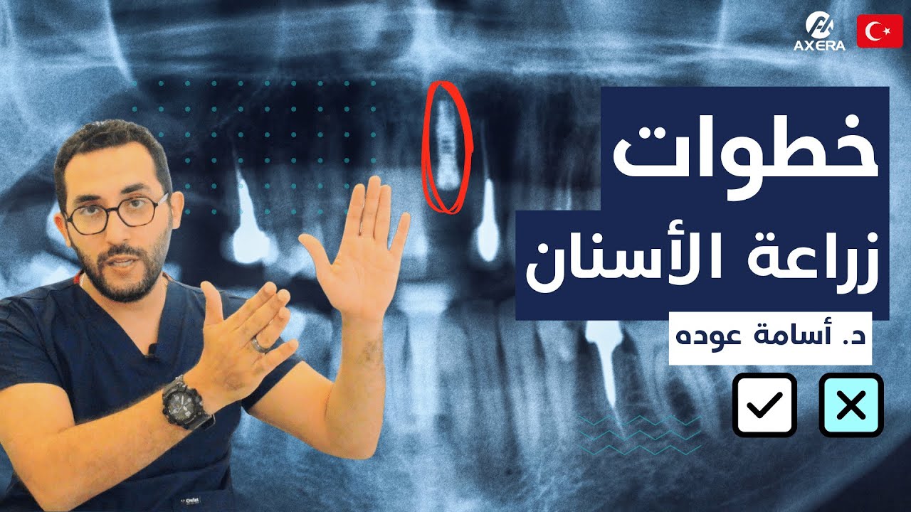 كيف تتم زراعة الاسنان؟ | زراعة الأسنان تركيا مع د. أسامة عوده